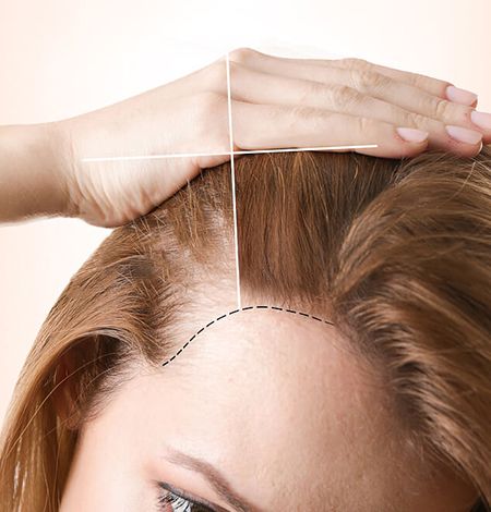 Female Hair Transplant