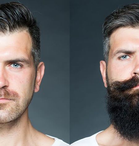 Beard Transplantation