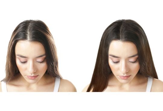 FEMALE HAIR TRANSPLANT