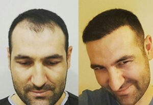 Best Hair Transplant in Turkey