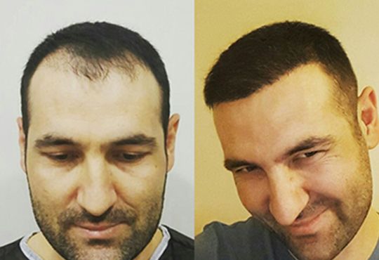 Best Hair Transplant in Turkey