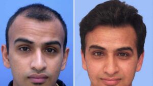 HAIR RESTORATION IN TURKEY